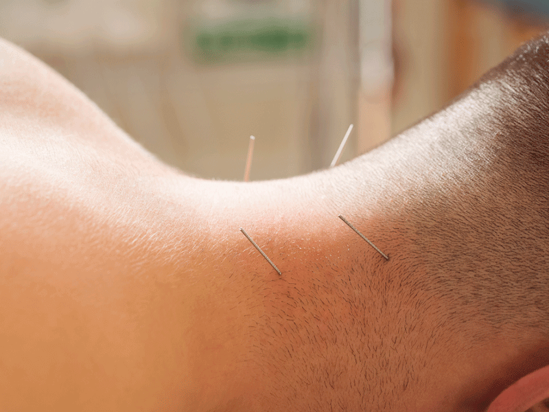 Tratamiento de punción seca en el cuello en clinica de fisioterapia fernando arco: alivio efectivo para tus molestias