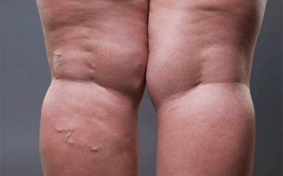 Cómo Eliminar la Retención de Líquidos