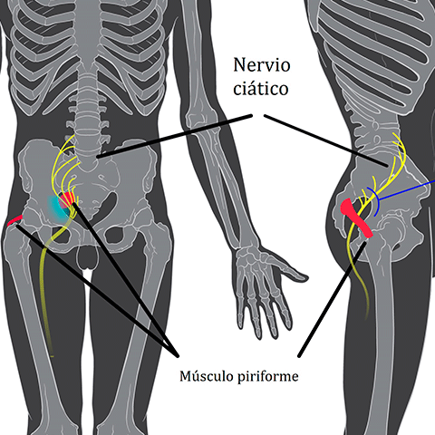 Radiografia cuerpo humano señalando musculo piramidal y nervio ciático