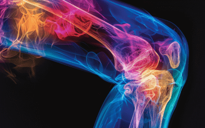 Rotura de Ligamento Cruzado: Rehabilitación Paso a Paso