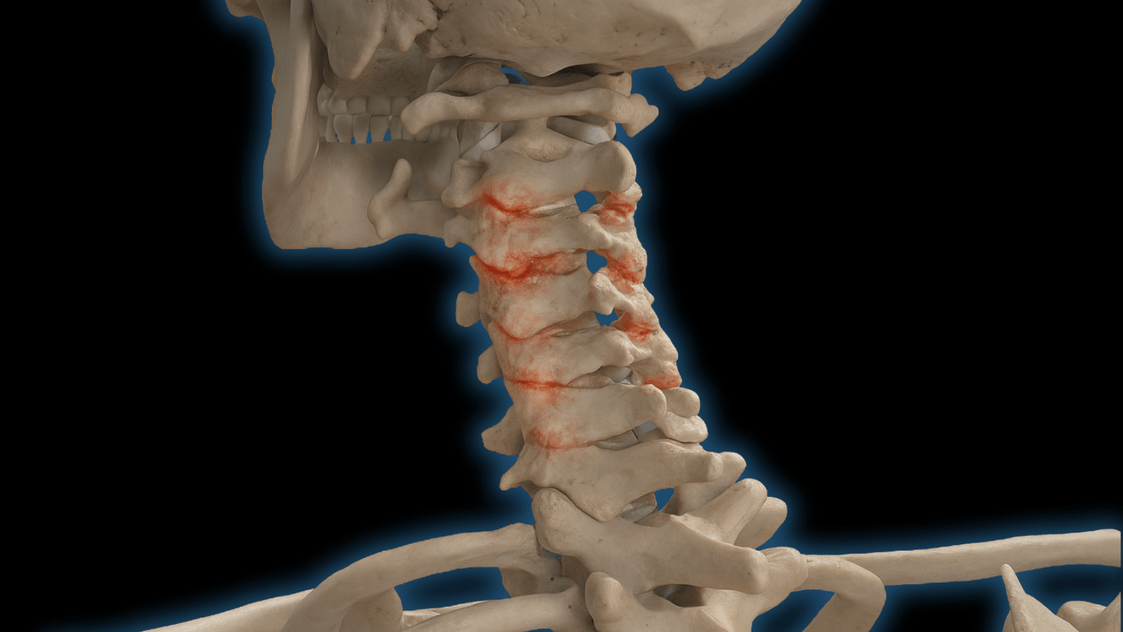 tratamiento-manual-artrosis-cervical-almeria (2) Ilustración 3D mostrando desgaste en vértebras cervicales típico de la artrosis cervical tratado en Fernando Arco Centro de Fisioterapia en Almería