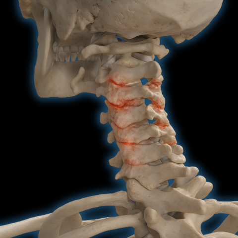 tratamiento-manual-artrosis-cervical-almeria Ilustración 3D mostrando desgaste en vértebras cervicales típico de la artrosis cervical tratado en Fernando Arco Centro de Fisioterapia en Almería