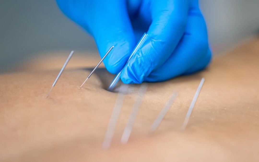 Punción Seca: Lo Que No Te Cuentan y Cuándo Evitarla